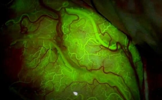 Доставят лекарства в мозъка с ултразвук